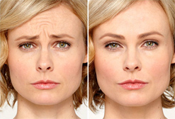 Maryland Botox Before and After Maryland Botox